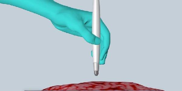 Tumori: una penna li diagnosticherà in 10 secondi