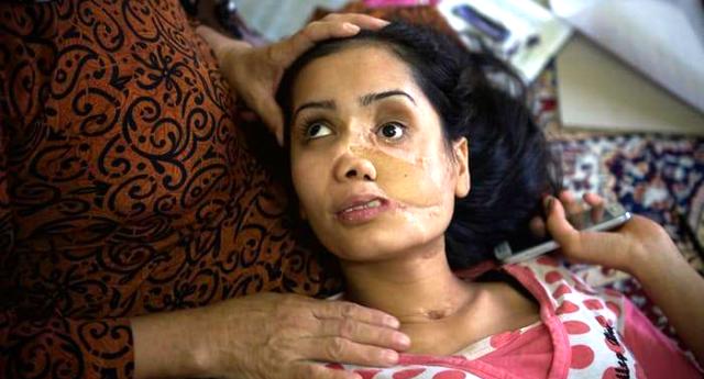 Costretta al matrimonio, sfigurata dal marito: il volto di Shakila è la tragedia di milioni di donne